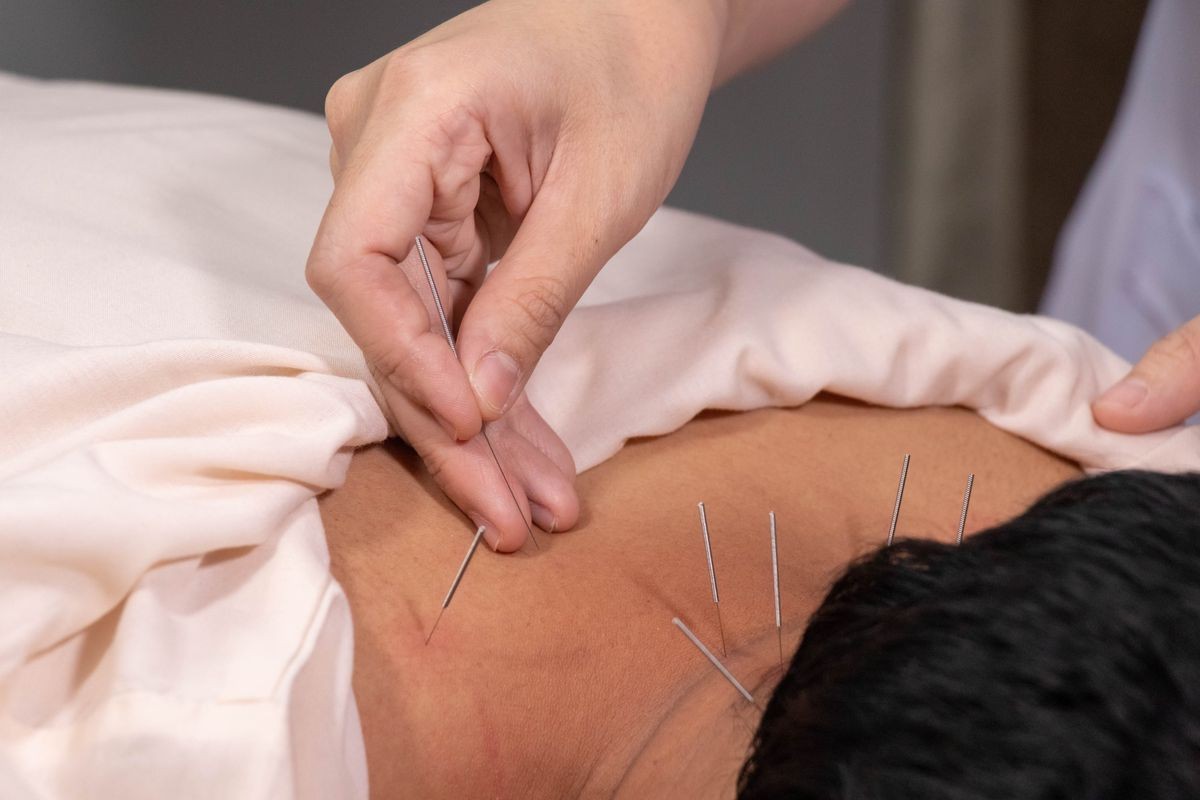 Traditional Chinese Medicine Acupuncture to treat men